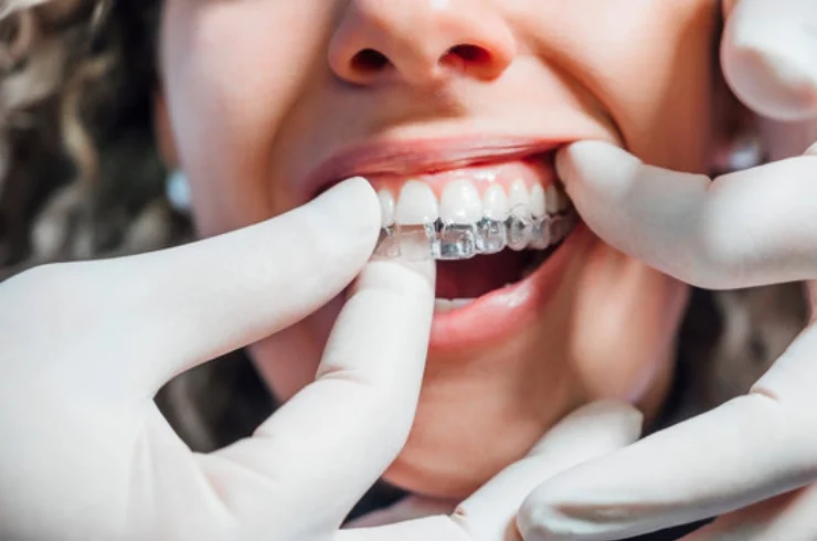 Invisible Aligners----